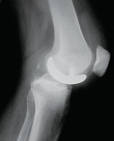 Illustration 54 for Knee Arthroplasty: Avoiding Pitfalls & Benefiting from UKA