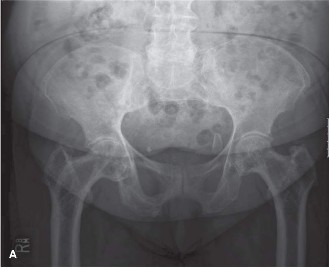 Unraveling Oncology Cases: Paget Disease Explained