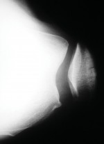 Illustration 79 for Knee Arthroplasty: Avoiding Pitfalls & Benefiting from UKA