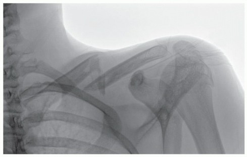 Plate Fixation of Clavicle: Preventing Nonunion & Improving Outcomes