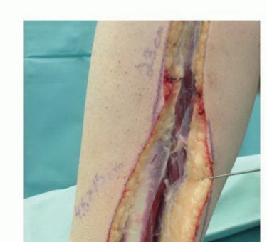 صورة طبية: ترقيع الشظية الوعائي الحر: حلول متقدمة لعيوب العظام المعقدة