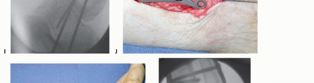 Illustration 7 for Unlock Ankle Preservation: Supramalleolar Closing Wedge Osteotomy