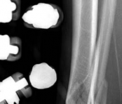 Illustration 7 for Decoding Pilon Fractures: Anterolateral and Medial Fragments Revealed