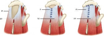Illustration 15 for Acad Orthop Surg Challenge: Diagnose Shoulder Pain Case 1
