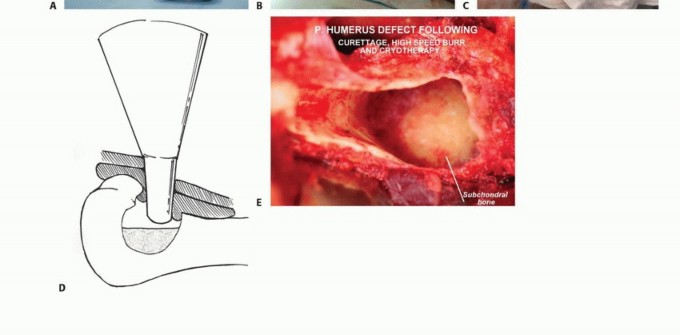 صورة توضيحية لـ تجنب الجراحة الكبرى: علاج أورام العظام بالنيتروجين السائل بتقنية الصب المباشر