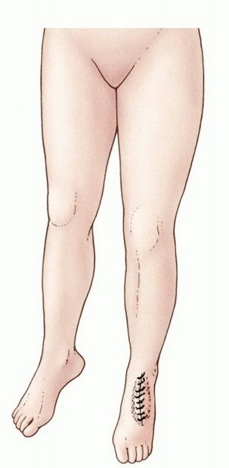 Below-Knee Amputation: Maximize Your Below-Knee Recovery & Function