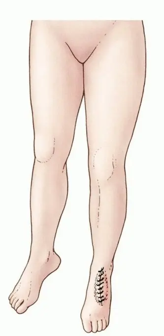 صورة توضيحية لـ بتر الساق تحت الركبة: دليل شامل للتعافي الأمثل واستعادة الوظيفة مع الأستاذ الدكتور محمد هطيف