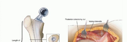 Well-Fixed THA Revisions: Precision in the Portion of the Osteotomy