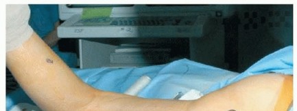 Effective Proximal Femoral Varus Osteotomy for Hip Stability