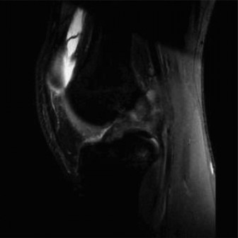 Illustration 6 for Pediatric OCD: When to Consider Drilling for the Femoral