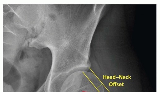 Illustration 7 for Restore Hip Health: Pelvic Osteotomy for Acetabular Dysplasia & CEA of Less