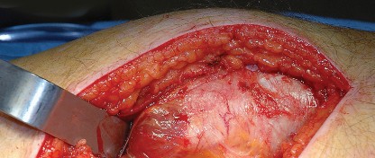 Illustration 14 for Unlock the Figure Posterior Approach to the Hip