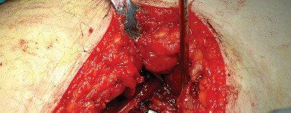 Illustration 46 for Unlock the Figure Posterior Approach to the Hip