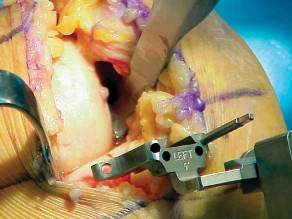 Illustration 35 for Unicompartmental Knee Arthroplasty: Master decisions with this b c figure guide.