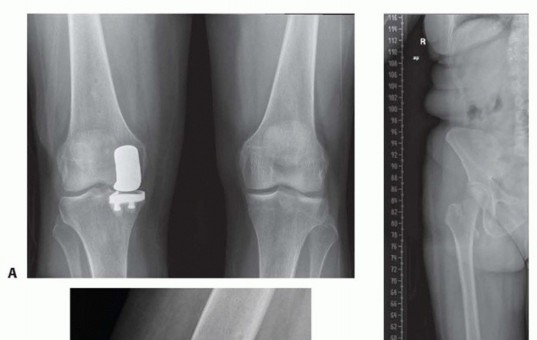 Illustration 25 for Unicondylar Knee Arthroplasty: Is This Your Solution to Knee Pain?