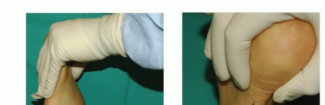 Foot Drop Surgery: How a Pin or Drill Elevates Tendon Transfer