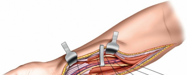 Illustration 98 for Mastering Approaches to the Upper Third of the Radius