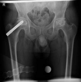 Illustration 3 for Is Your Femoral Head Affected? Understanding Hip Osteoarthritis