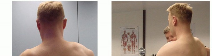 Beyond Winging: Scapulothoracic Arthrodesis for the Scapula Surface