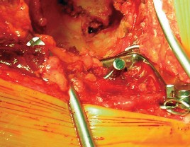 صورة طبية: طول عمر مكون الحُق الأسمنتي في مفصل الورك: مفتاح الاستقرار والديمومة مع الأستاذ الدكتور محمد هطيف في صنعاء