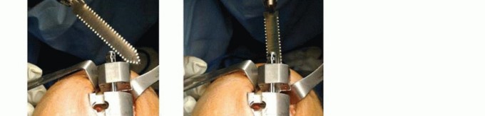 Illustration 7 for Unicondylar Knee Arthroplasty: Is This Your Solution to Knee Pain?