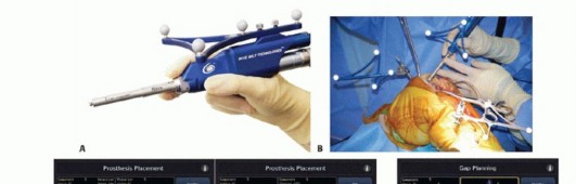 Illustration 21 for Unicondylar Knee Arthroplasty: Is This Your Solution to Knee Pain?