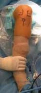 صورة توضيحية لـ القدم الحنفاء (Clubfoot): أسبابها، أعراضها، وأحدث طرق علاجها مع الأستاذ الدكتور محمد هطيف