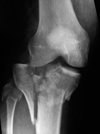 Illustration of case tibial plateau - Dr. Mohammed Hutaif