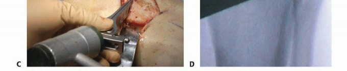 Illustration 16 for High Tibial Osteotomy: Realignment for Lasting Knee Pain Relief