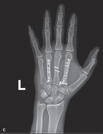 Illustration 2 for Open Reduction for Multiple Metacarpal Fractures: Case Review