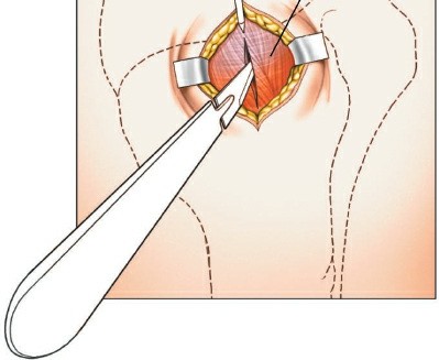 Illustration 4 for Step-by-Step Guide: Minimally Invasive Approach to the Proximal Humerus