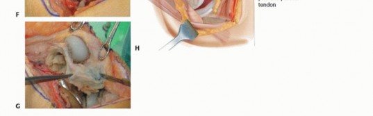 Illustration 8 for Tibial Tubercle Osteotomy: The Key to Extensile Exposure in Revision TKA