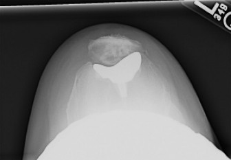 Mastering Various Prosthesis Designs & Patient Indications