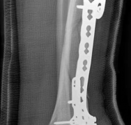 Illustration 20 for Complex Tibial Shaft Fracture: Plate Fixation for Plafond Extension