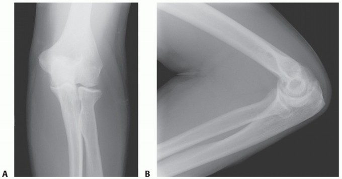 Elbow Contracture: Continuous Passive Motion for Lasting Relief