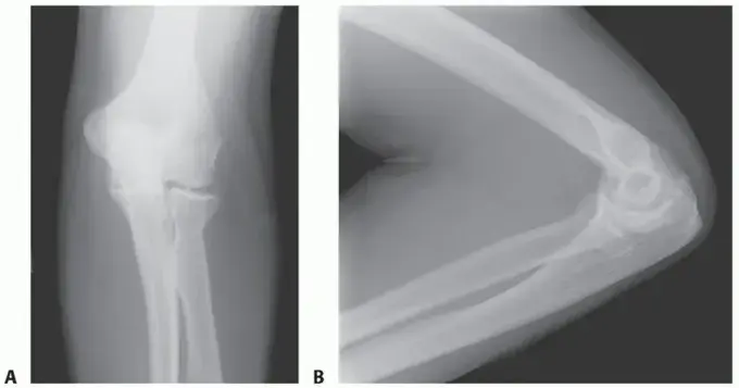صورة توضيحية لـ علاج تصلب المرفق: دليلك الشامل لاستعادة حركة ذراعك الطبيعية