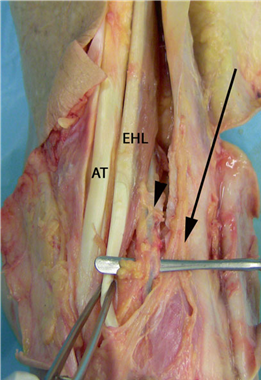 Illustration 3 for First Metatarsal Surgery: Expert Solutions for Foot & Ankle Pain