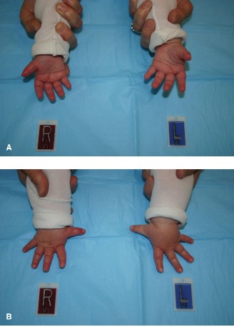 Hypoplastic Thumb: Rebuilding the First Web Space for Lasting Function