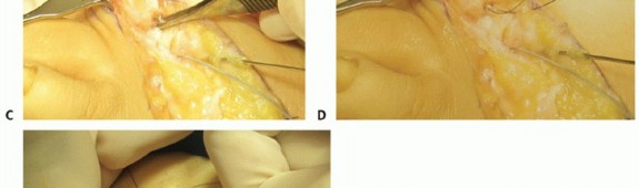Illustration 28 for Plantar Plate Repair: End Lesser Toe Pain & Instability