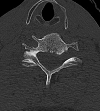 Illustration 17 for Adjacent Segment Degeneration: Your Next Spine Case Solved