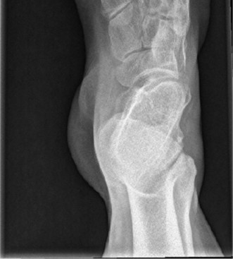 Illustration 3 for Pes Cavus & Ankle Pain: When to Use Coleman Block Testing