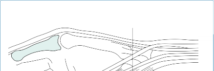 صورة طبية: جراحة الرسغ المتقدمة: دليل شامل لخيارات العلاج والتعافي مع الأستاذ الدكتور محمد هطيف في صنعاء