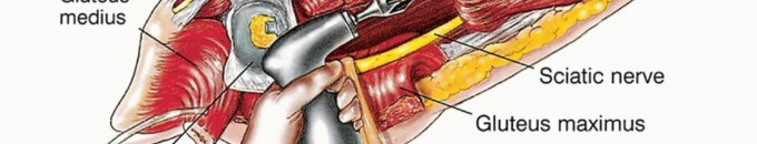 Illustration 34 for Beyond Amputation: Total Femur Resection with Endoprosthetics