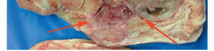 صورة توضيحية لـ أورام القدم: دليلك الشامل للعلاج، البتر، والاستئصال مع الأستاذ الدكتور محمد هطيف في صنعاء