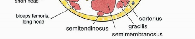 صورة توضيحية لـ استئصال ساركوما العضلة الرباعية مع الحفاظ على الطرف: دليل شامل للمرضى مع الأستاذ الدكتور محمد هطيف في صنعاء