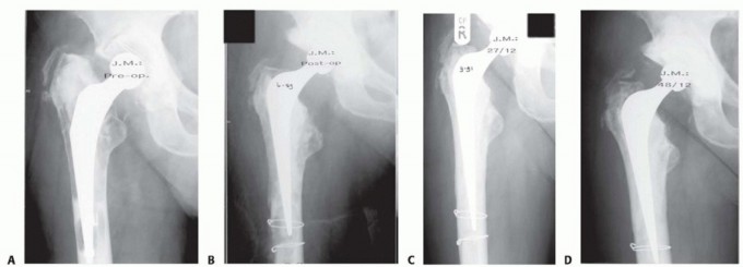 Exeter Hip Unit: Mastering Impaction Allografting for Femoral Bone Loss