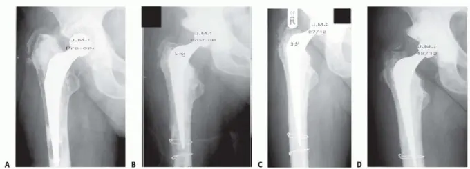 صورة توضيحية لـ وحدة إكستر للورك: إتقان تطعيم العظام بالضغط لمعالجة فقدان عظم الفخذ في صنعاء مع الأستاذ الدكتور محمد هطيف
