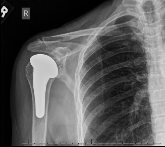 Illustration 54 for Acad Orthop Surg Challenge: Diagnose Shoulder Pain Case 1