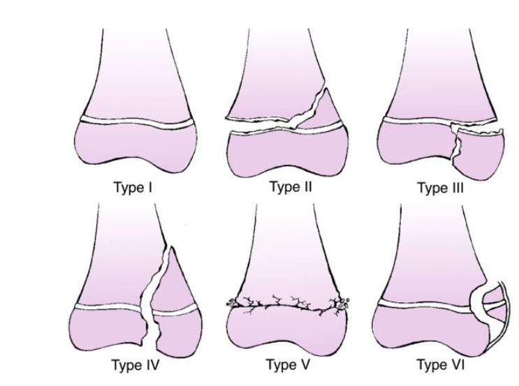 إصابات الركبة عند الأطفال: دليلك الشامل للكسور والخلوع والعلاج