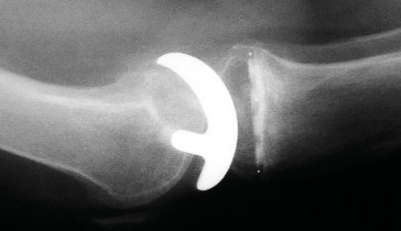 Illustration 39 for Knee Arthroplasty: Avoiding Pitfalls & Benefiting from UKA